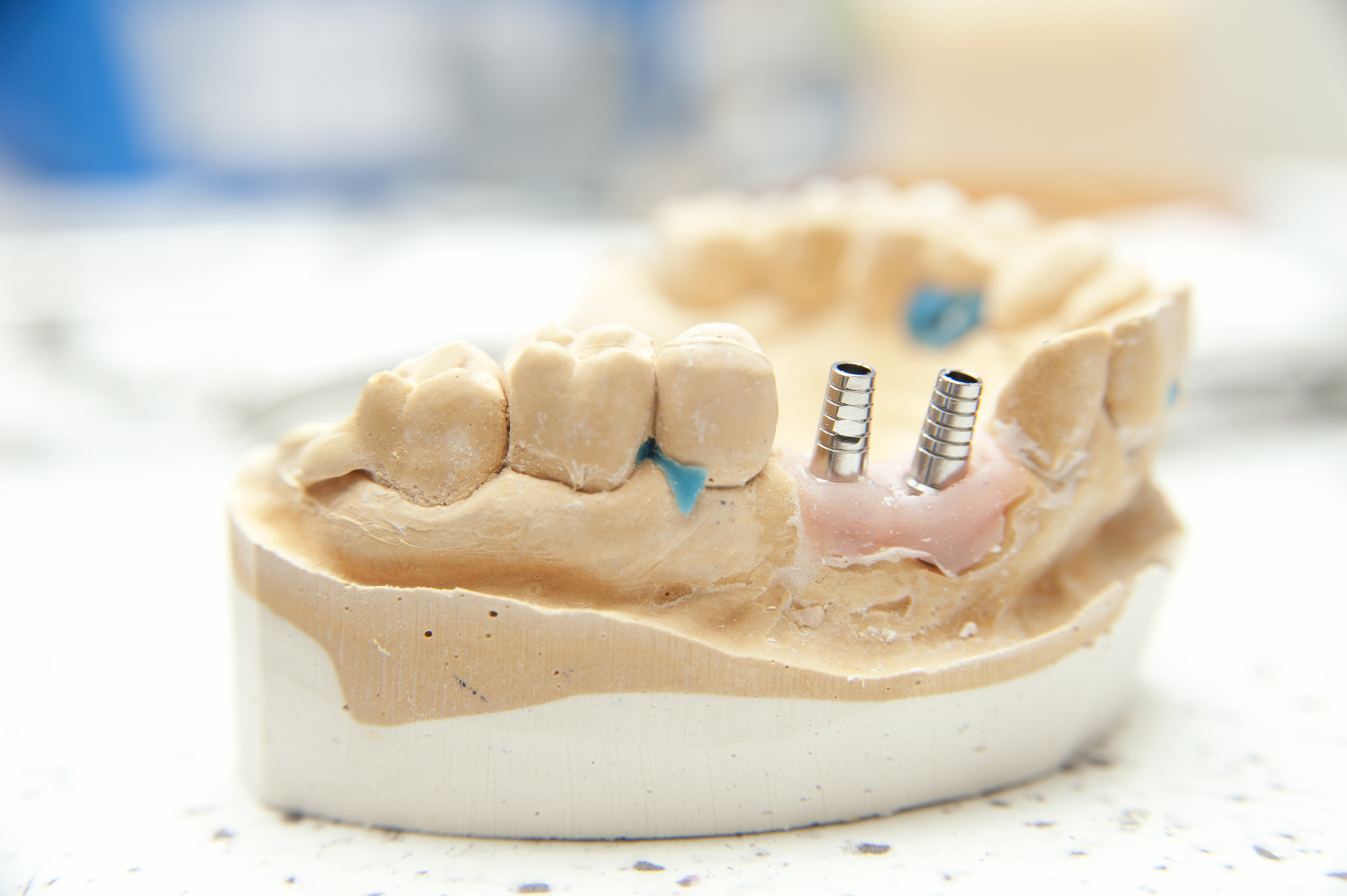 Implants dentaires simples à entretenir